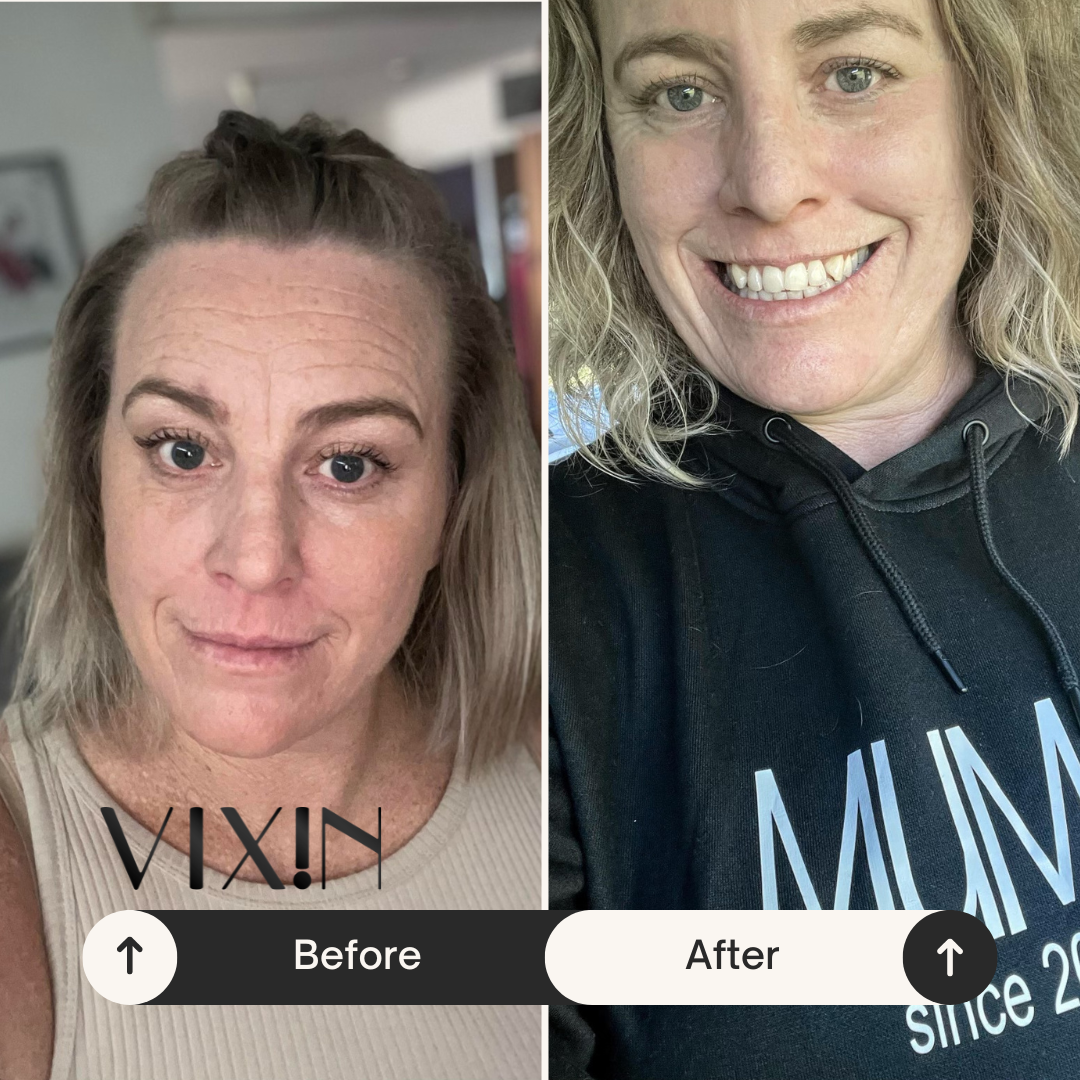 Vixin All In One Apple Stem Cell Face Cream 50mL – certified Australian made moisturiser Before and after