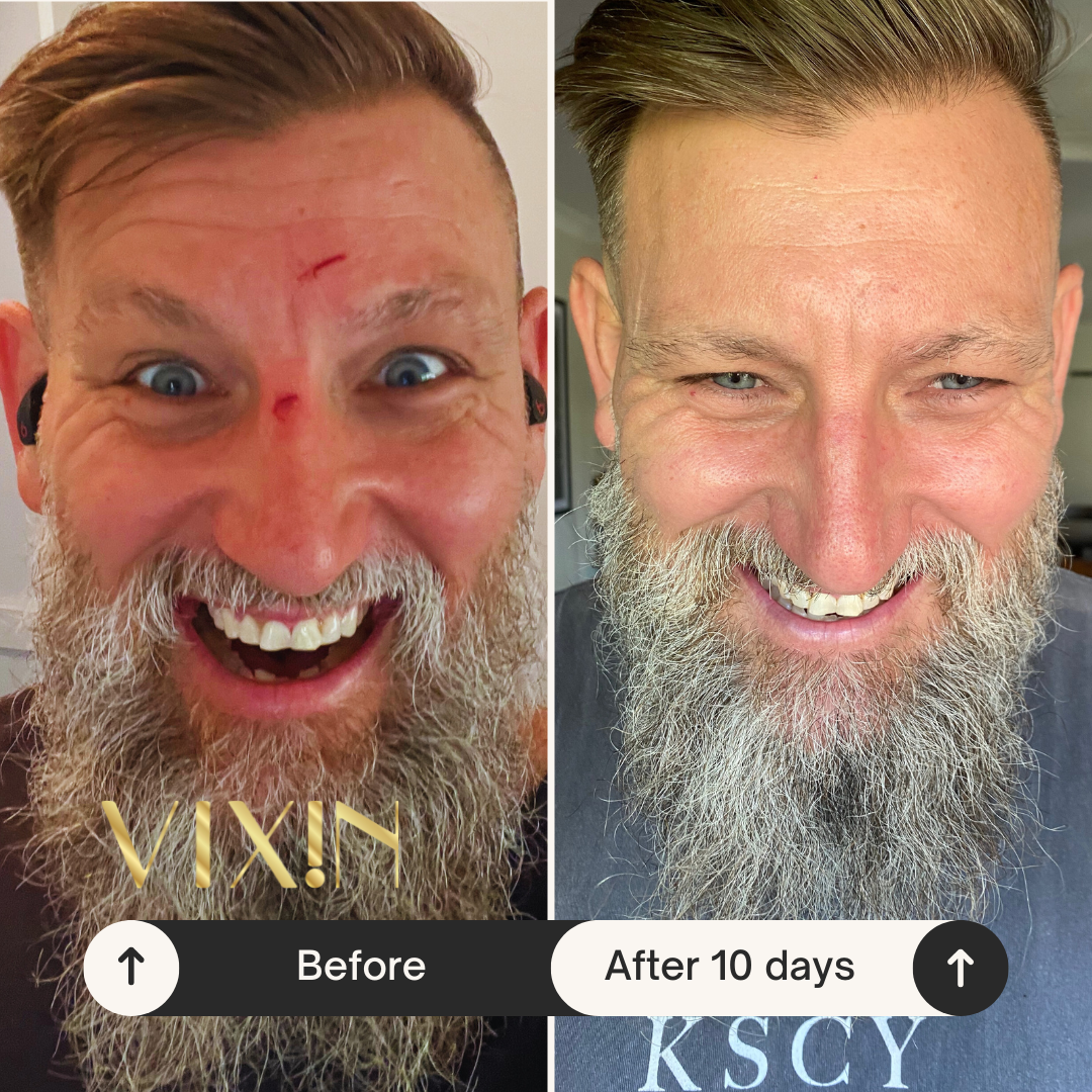 Vixin All In One Apple Stem Cell Face Cream 50mL – certified Australian made moisturiser Before and after men