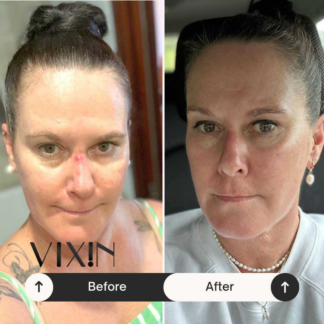 Vixin before and after photo of redness and skin tone
