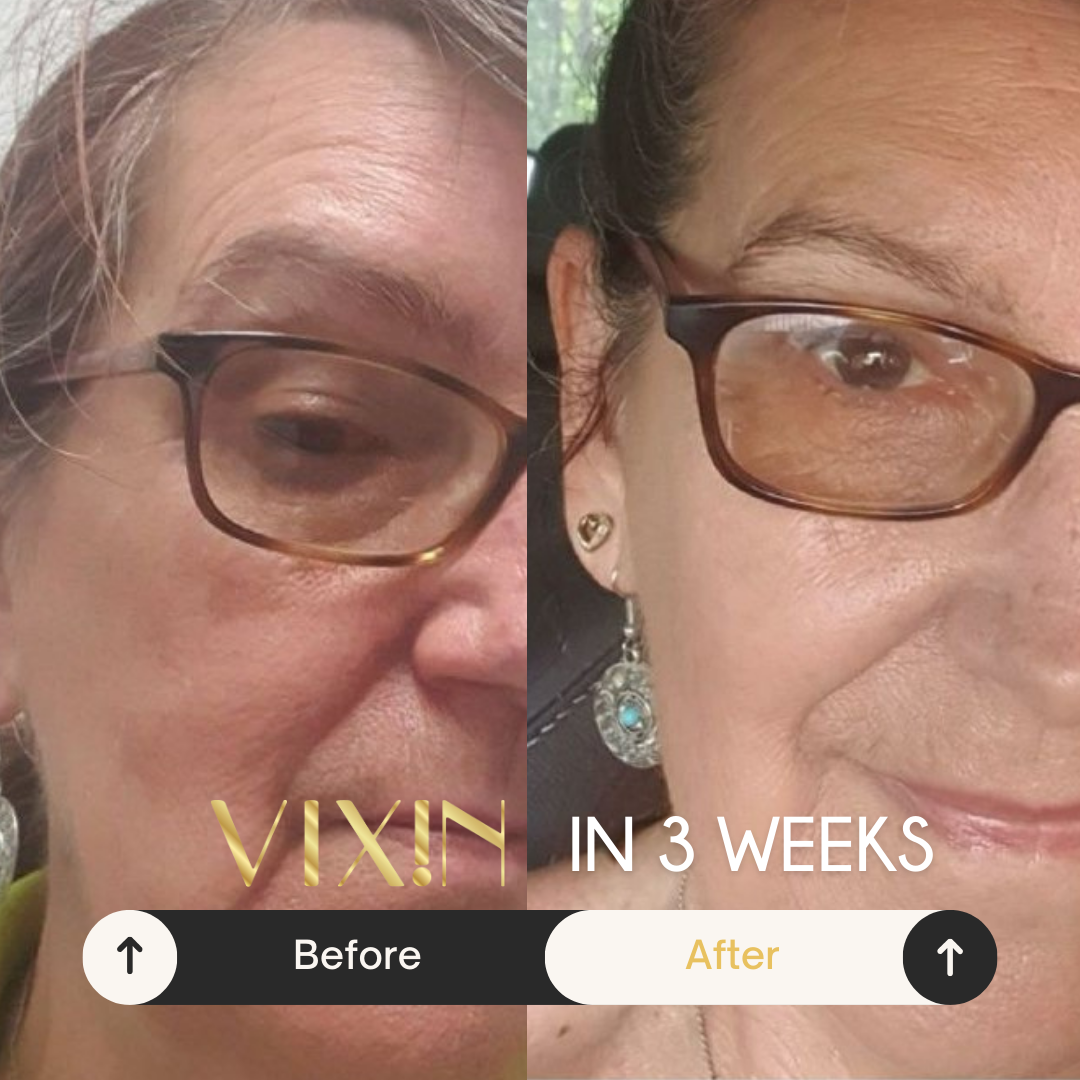 VIXIN 3 weeks Before and after comparison of a woman wearing glasses with Vixin Australian made