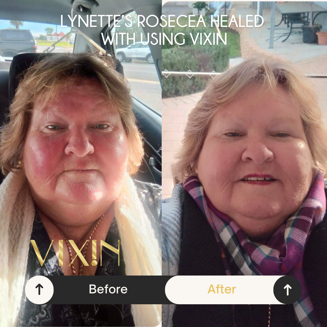 vixin Before and after comparison of a woman using Vixin, with text indicating 'Lynette's Rosacea Healed with Using Vixin'