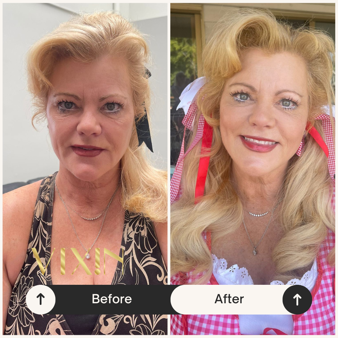 VIXIN before and after comparison of a mature woman , after only 2 weeks peptides antioxidants