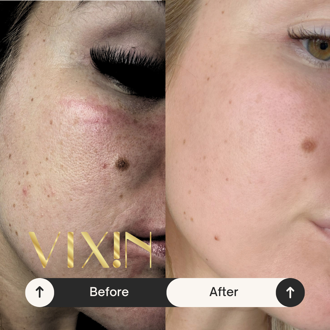 Vixin All In One Apple Stem Cell Face Cream 50mL – certified Australian made moisturiser Before and after