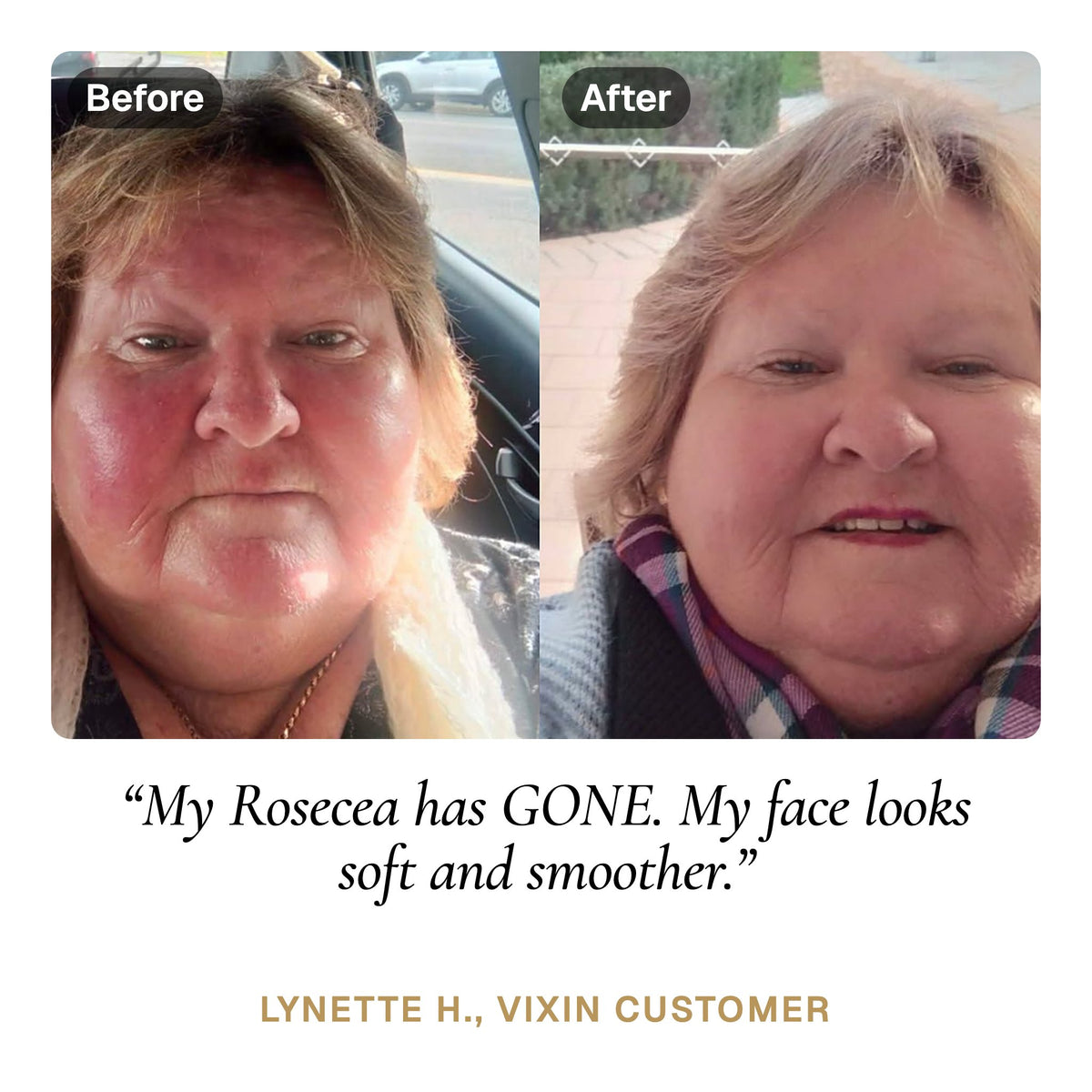 Lynette H. before and after: My Rosecea has GONE. My face looks soft and smoother.