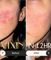 Vixin All In One Apple Stem Cell Face Cream 50mL – certified Australian made moisturiser Before and after