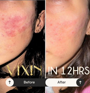 Vixin All In One Apple Stem Cell Face Cream 50mL – certified Australian made moisturiser Before and after