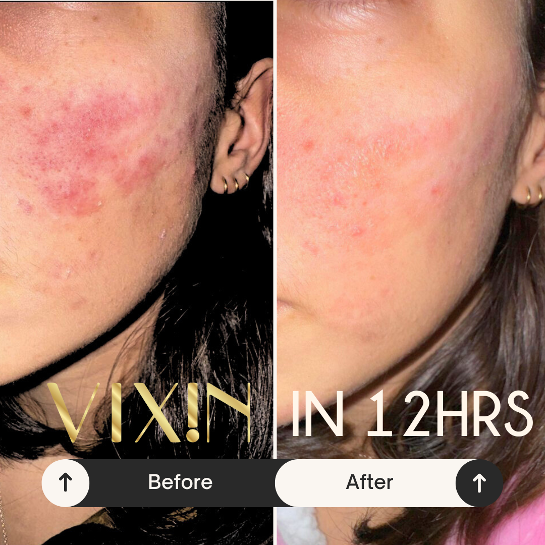 Vixin before and after photo of facial redness