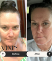 Vixin All In One Apple Stem Cell Face Cream 50mL – certified Australian made moisturiser Before and after