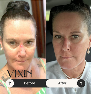 Vixin All In One Apple Stem Cell Face Cream 50mL – certified Australian made moisturiser Before and after