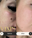 Vixin All In One Apple Stem Cell Face Cream 50mL – certified Australian made moisturiser Before and after