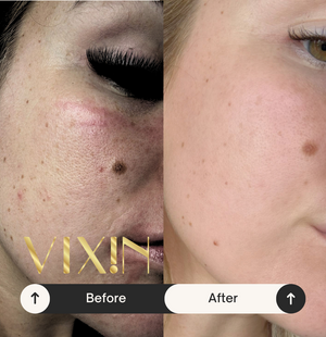 Vixin All In One Apple Stem Cell Face Cream 50mL – certified Australian made moisturiser Before and after